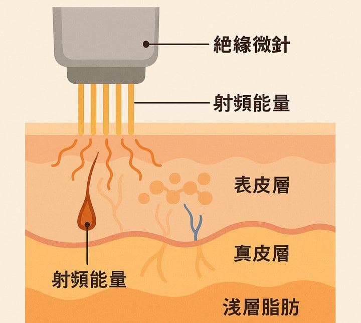 微針電波 是什麼?比電波拉皮更深入的拉提科技,一次改善鬆弛、毛孔與膚質 - 第1張圖