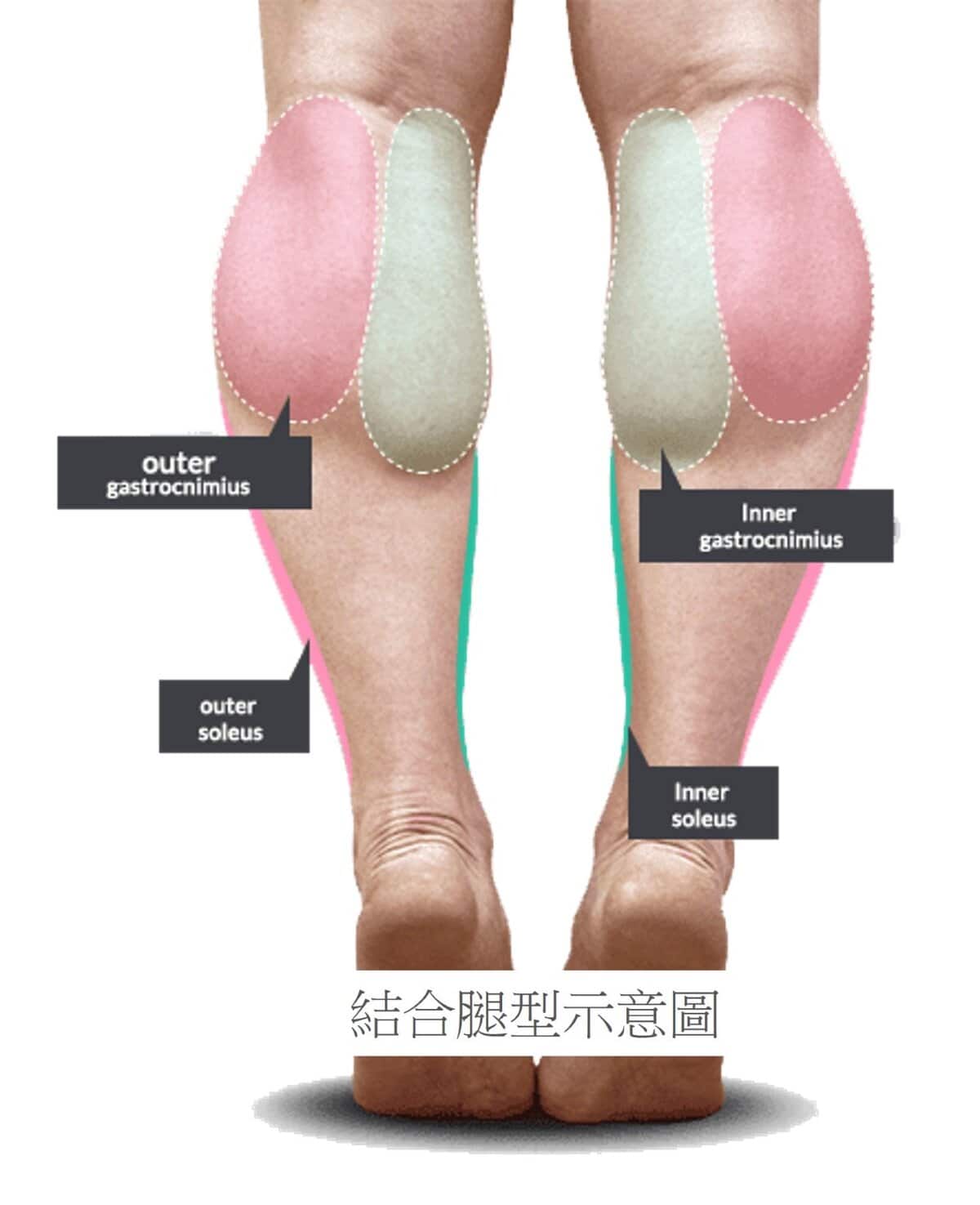 超音波瘦小腿 精準注射打造曲線美腿，腓腸肌與比目魚肌的塑型關鍵，更準確也更安全