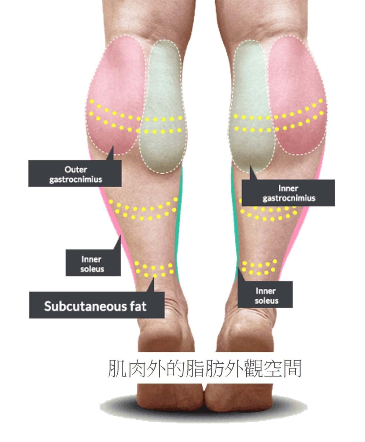 超音波瘦小腿 精準注射打造曲線美腿，腓腸肌與比目魚肌的塑型關鍵，更準確也更安全