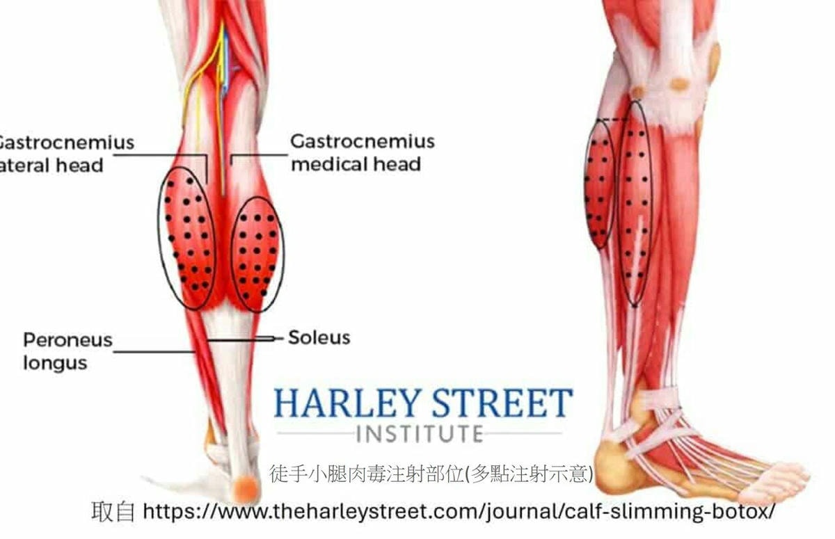 超音波瘦小腿 精準注射打造曲線美腿，腓腸肌與比目魚肌的塑型關鍵，更準確也更安全