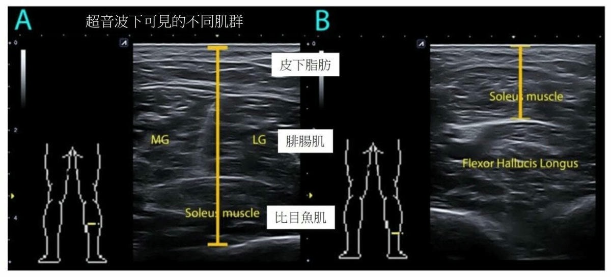 超音波瘦小腿 精準注射打造曲線美腿，腓腸肌與比目魚肌的塑型關鍵，更準確也更安全