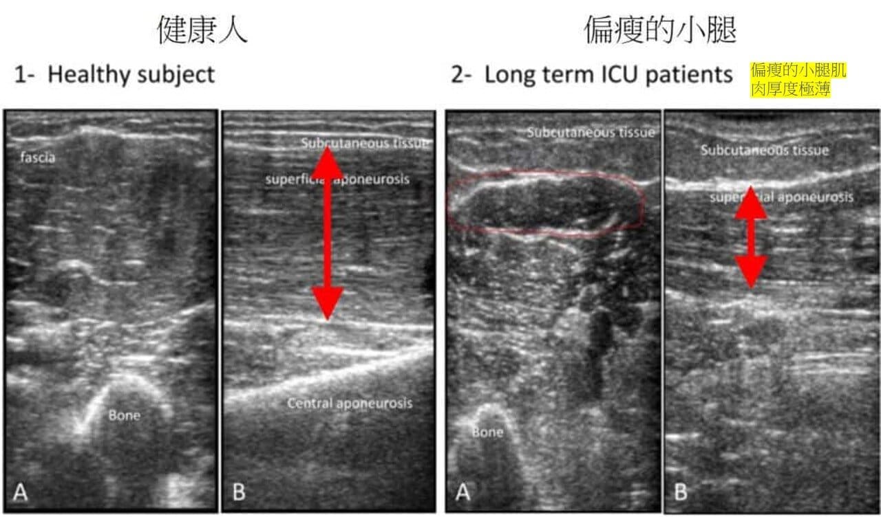 超音波瘦小腿 精準注射打造曲線美腿，腓腸肌與比目魚肌的塑型關鍵，更準確也更安全
