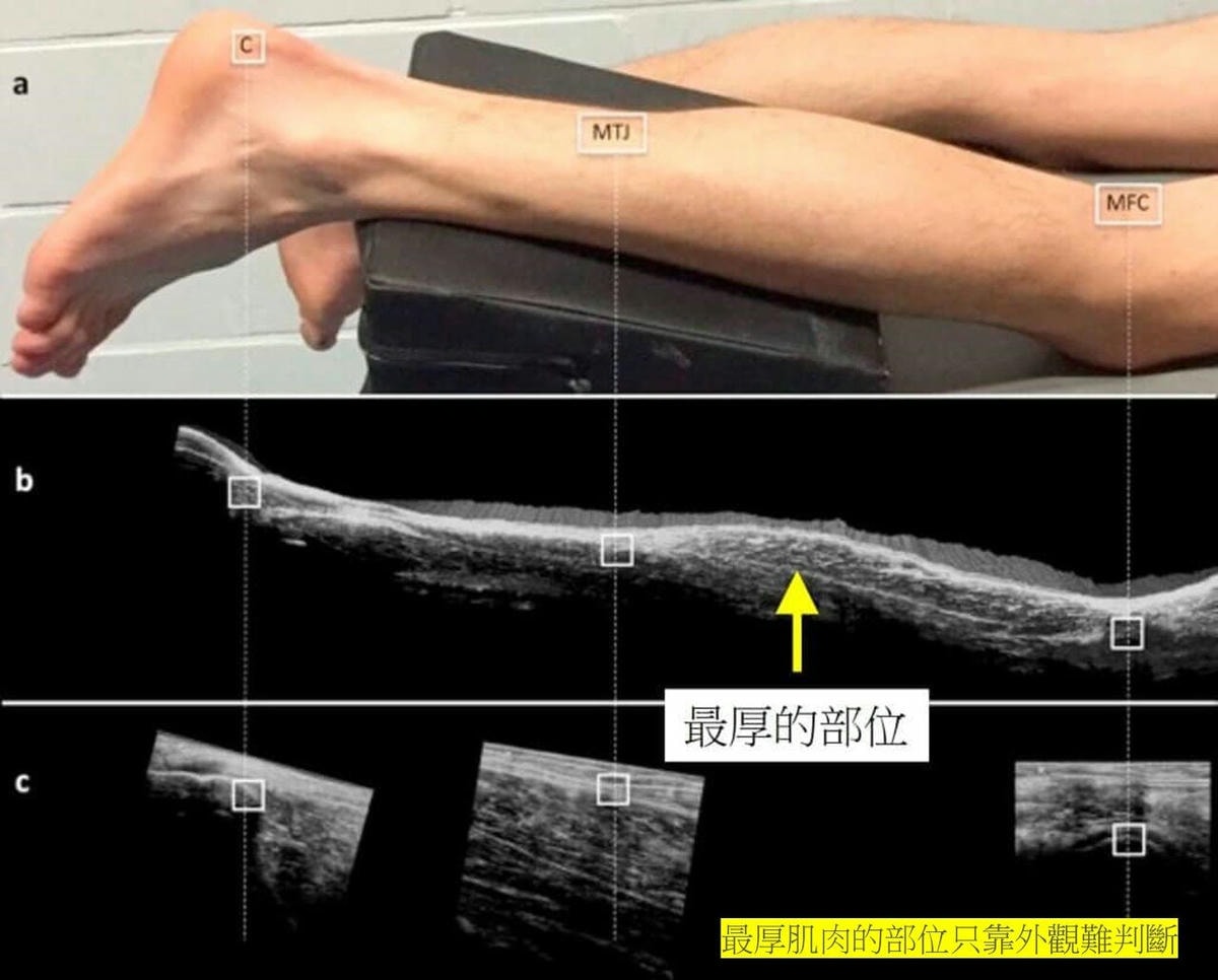 超音波瘦小腿 精準注射打造曲線美腿，腓腸肌與比目魚肌的塑型關鍵，更準確也更安全