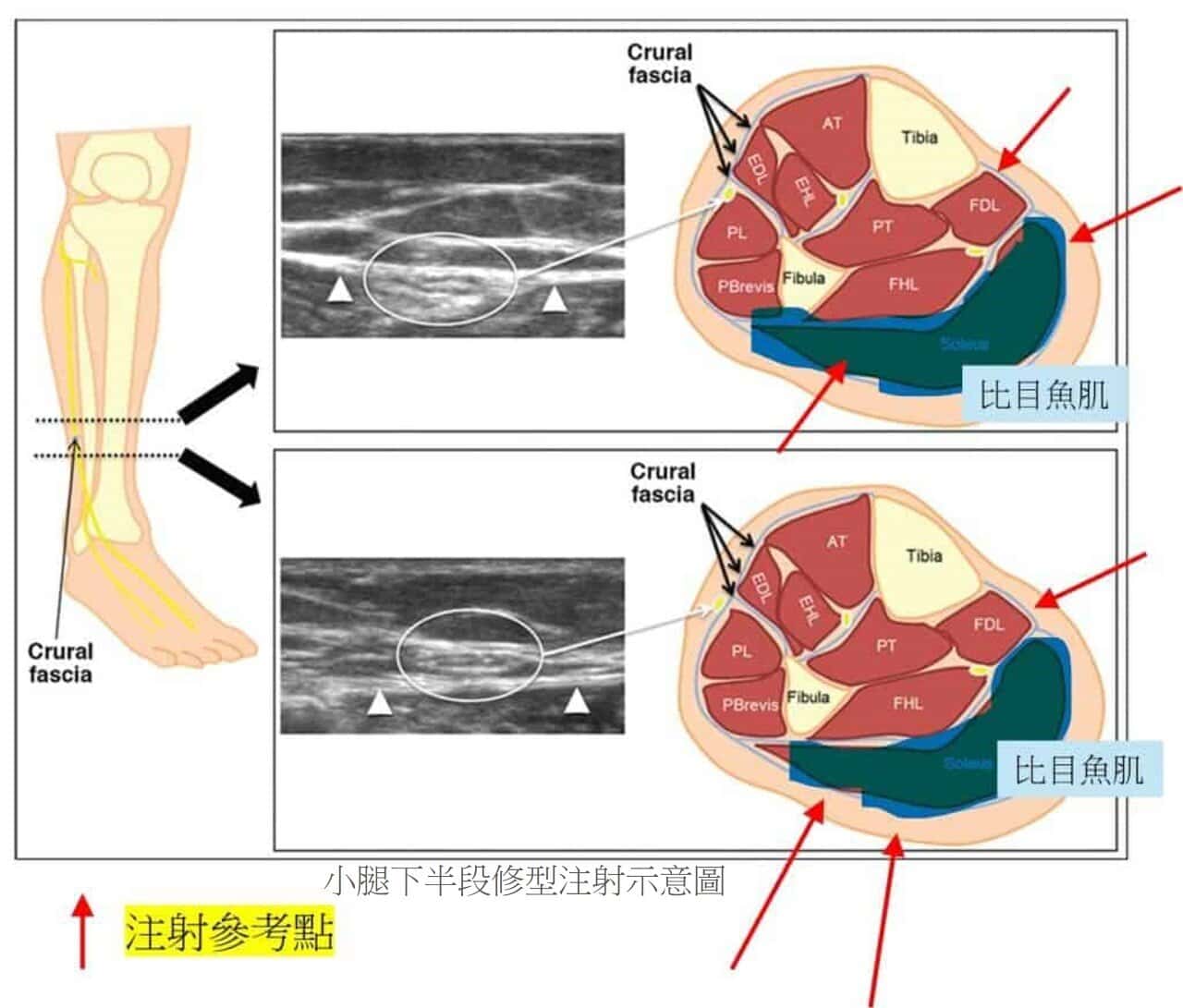 超音波瘦小腿 精準注射打造曲線美腿，腓腸肌與比目魚肌的塑型關鍵，更準確也更安全
