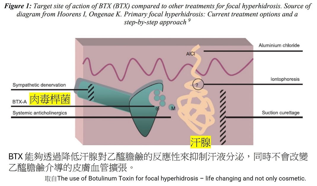 肉毒桿菌素治療 多汗症 : 從原理到臨床應用 - 第1張圖